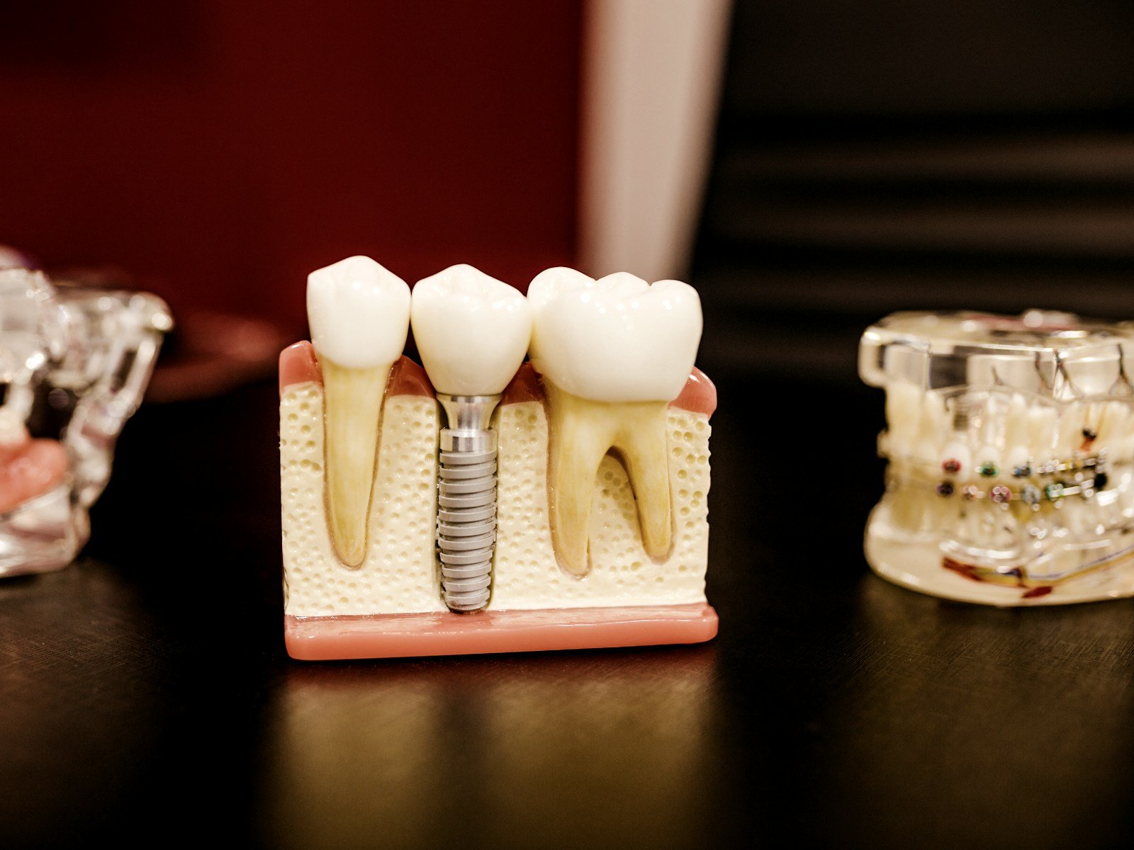 Dental implant model at Glenrothes Dental House