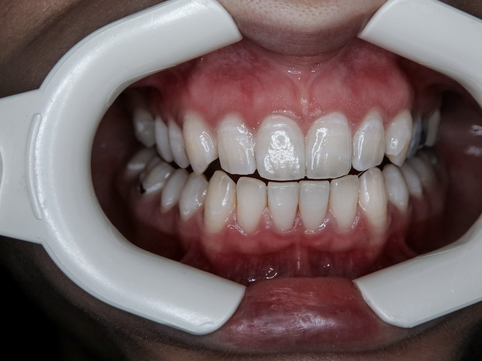 Dental crowns at Glenrothes Dental House