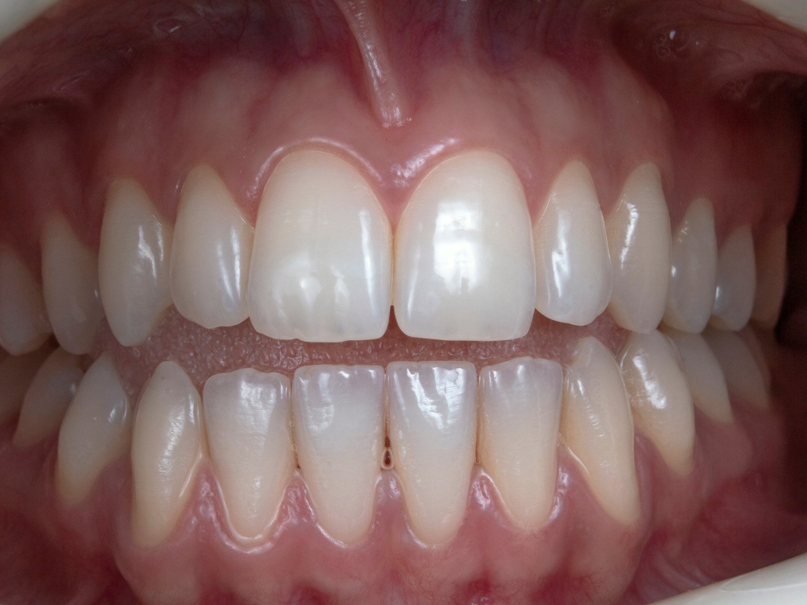 Composite bonding result at Glenrothes Dental House